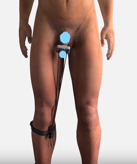 Un dispositivo para aumentar un miembro