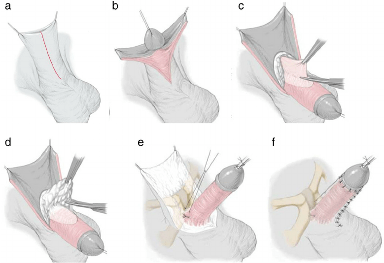 Ligamentotomía para agrandar el pene.